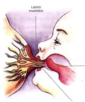 Inversión de los labios del niño al succionar leche materna Inversión de los labios del niño al succionar leche materna