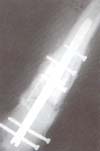 Radiografia de control