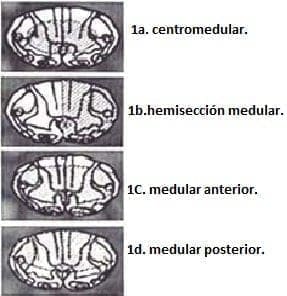 Diagnóstico clínico de síndromes medulares