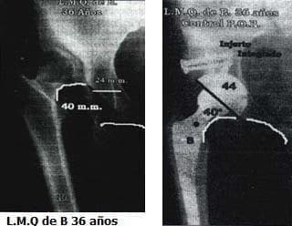 Deformidad en aducción y rotación externa, Escala de Harris de 27 Deformidad en aducción y rotación externa, Escala de Harris de 27