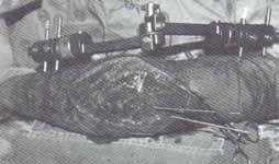 Aspecto transoperatorio de la osteosistesis