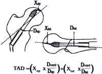 Forma de calcular la distancia punta-apex (TAD)