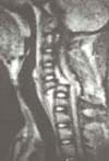 Luxifractura cervical C5-C5