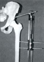 Area de inserción tornillos cónicos del domo acetabular