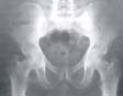 Radiografia de un PA bilateral