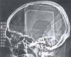 Tomografía axial computarizada - escanograma
