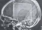 Tomografía axial computarizada linea orbitomeatal