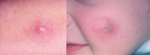 Características de la Atención en Guía de Atención de la Leishmaniasis