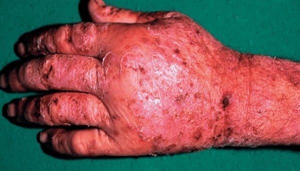 Instrumento de Evaluación para Dermatitis de Contacto Ocupacional