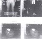Tomografía axial de extensión obliteración del canal