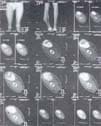 Tomografía axial del canal medular y la discrepancia de longitud