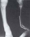 Seudoartrosis congénita de tibia tipo V de Boyd7 en niño
