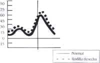 Rodilla derecha postquirúrgica - Parálisis Cerebral Espástica