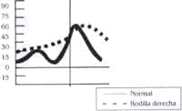 Rodilla derecha prequirúrgica - Parálisis Cerebral Espástica