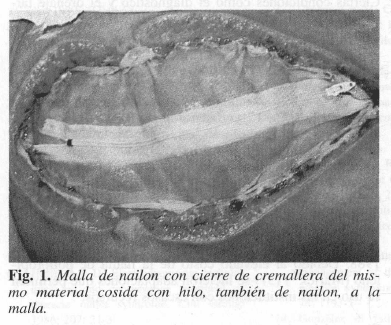 Malla de nailon en Sepsis Intraabdominal Malla de nailon en Sepsis Intraabdominal