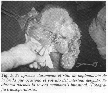 Vólvulo del intestino delgado