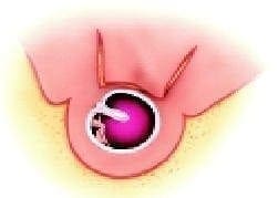 Canaloplastia