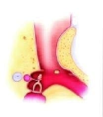 Colgajo medial