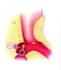 Canaloplastia