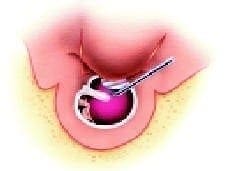Canaloplastia