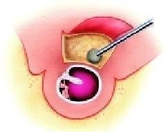 Canaloplastia