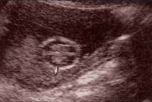 Diagnóstico Prenatal -  Desarrollo del polo cefálico