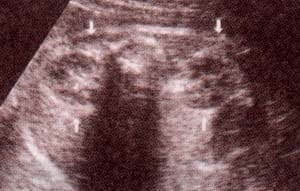 Abdomen Fetal, se visualizan los dos riñones