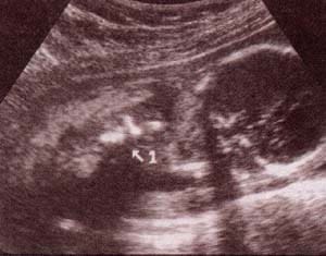 Diagnóstico Prenatal - cintura escapular