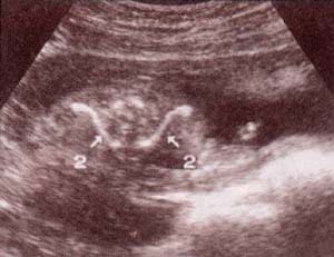 Diagnóstico Prenatal - cintura escapular