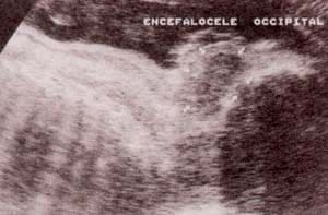 Encefalocele occipital