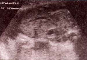 Onfalocele y Gastrosquisis