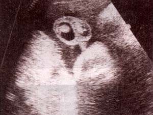 Hidrocele Bilateral