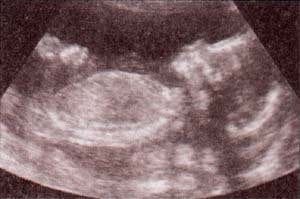 Edad gestacional realizar una valoración del perfil bastante aproximada.