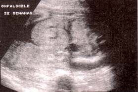 Onfalocele en un feto afecto de trisoma 13 Onfalocele en un feto afecto de trisoma 13