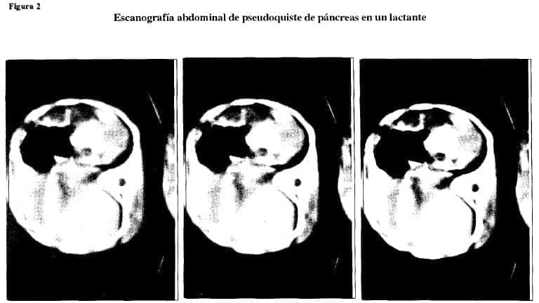 Escanografía abdominal pseudoquiste