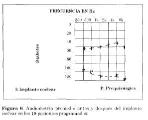 Audiometría resultado implante coclear