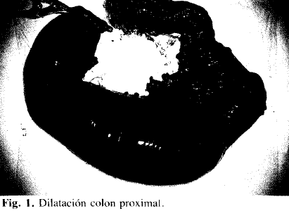 Dilatación colon proximal