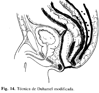 Técnica de Duhamel modificada