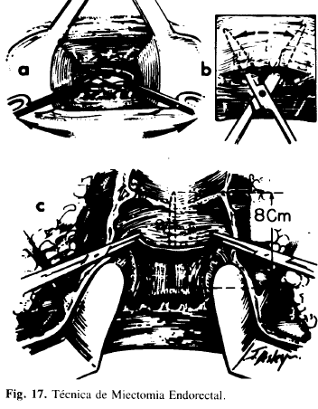 Técnica de Miectomia Endorectal