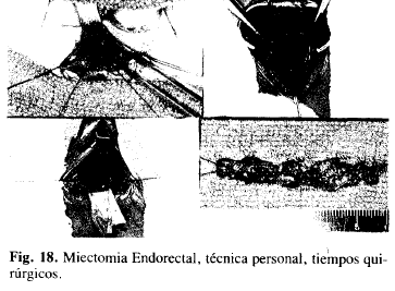 Miectomia Endorectal, técnica personal, tiempos quirúrgicos