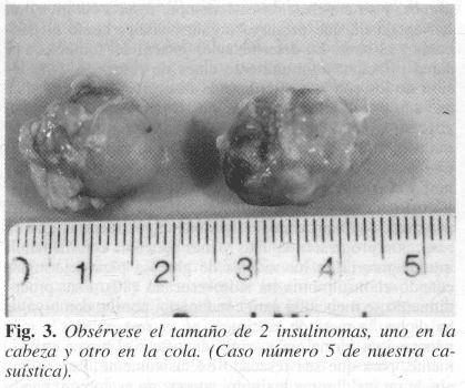Insulinomas, uno en la cabeza y otro en la cola