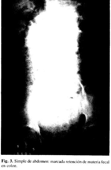 Simple de abdomen: marcada retención de materia fecal en colon