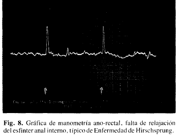 Manometría ano-rectal, esfinter anal intemo. típico  Hirschsprung