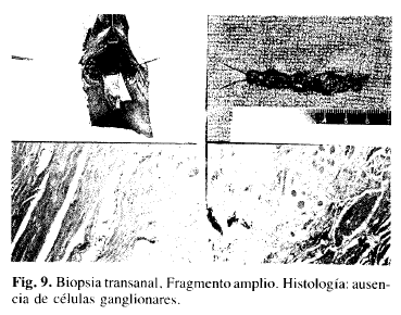 Biopsia Transanal. Histología: ausencia de células ganglionares