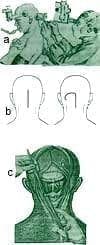 Craneotomía Osteoclástica de la Fosa Posterior