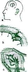 Craneotomía Osteoclástica