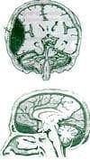 Hematoma Epidural
