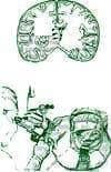 Craneotomía para Resección de Tumor Cerebral