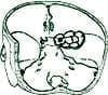 Meningioma de la Base del Cráneo