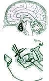 Craneotomía Transfrontal para Adenoma Gigante de Hipófisis